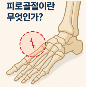 피로골절 증상부터 치료와 회복기간까지 완벽 정리